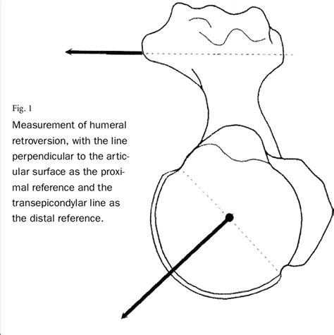 humeral torsion test|humeral retroversion treatment.